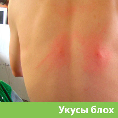 Укусы блох в Сарапуле