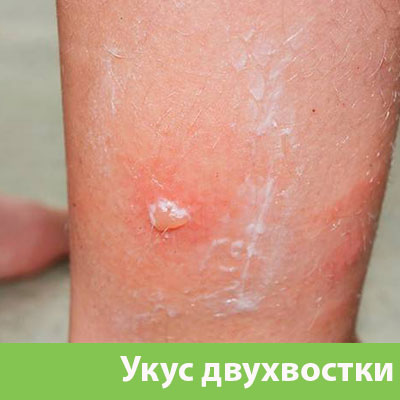 Укус двухвостки в Сарапуле