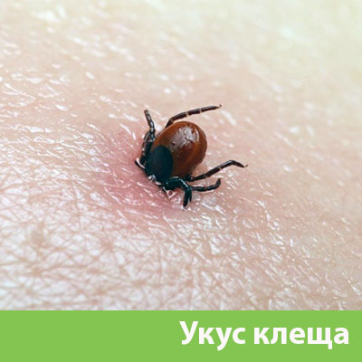 Укус клеща в Сарапуле
