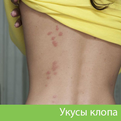Профессиональное уничтожение клопов в Сарапуле